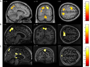 FMRI activation observed during the spatial navigation imagery task for a group of healthy participants (A) and two completely locked-in GBS patients (B and C). (A) In healthy participants, a whole-brain group analysis revealed significant activation in the occipito-parietal junction, cerebellum, parahippocampal gyrus, and left middle frontal gyrus using a threshold of p < .05, FDR-corrected for multiple comparisons. Group analysis is shown on a canonical single-subject T1 MRI image. (B) In patient 1 a whole-brain analysis revealed significant activation in the occipito-parietal junction with results displayed at a peak voxelwise threshold p < .001, uncorrected followed by whole-brain FDR-corrected for significance using cluster extent, p < .05 and displayed on the patient's normalized T1 image. (C) Patient 2 had weaker activation in the occipito-parietal junction with results displayed at a peak voxelwise threshold of p < .001, uncorrected for multiple comparisons for visualization.