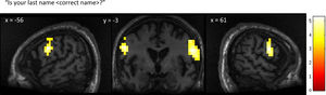 Patient 1’s whole-brain response to a question asking about his correct last name. Significant bilateral activation was observed in the lateral premotor cortex. Results displayed at a peak voxelwise threshold p < .001, uncorrected followed by whole-brain FDR-corrected for significance using cluster extent, p < .05 and displayed on the patient's normalized T1 image.