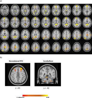 Univariate differential activations during acquisition in the threat circuitry a) whole brain analysis, b) ROI analysis (CS+ > CS-). All statistical maps represent group results after mixed effect analysis (z > 2.3, cluster-corrected p <0.05).
