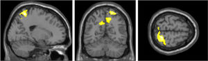 Main clusters in the primary somatosensory area (postcentral gyrus) and superior parietal lobule (precuneus) given the true belief stimulation < sham contrast from the whole-brain one-way within subjects ANOVA. MNI coordinates from left to right: x = 20 y = −59 z = 65.