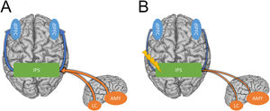 Potential model showing how the IPS may mediate hyperarousal and hypervigilance symptoms in anxiety disorders. A) Strong connectivity between the IPS and the dlPFC facilitates bottom-up processing of threat-related stimuli leading to hypervigilance (Blue arrows). Strong connectivity between subcortical regions like the amygdala and locus coeruleus and the IPS elevate arousal (Orange arrows). B) Inhibitory TMS protocols may alleviate hypervigilance and hyperarousal symptoms in PTSD and anxiety by weakening the connections between the IPS and the cortical/sub-cortical regions involved in these symptoms.