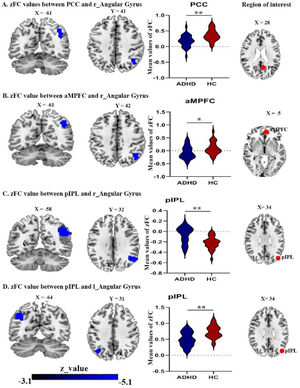 Brain areas showing significantly reduced connectivity with default mode network seeds in the ADHD group compared with the control group(A) right angular gyrus with PCC seed; (B) right angular gyrus with aMPFC seed; (C) right angular gyrus with pIPL seed; (D) the left angular gyrus with pIPL seed. Abbreviations: PCC, posterior cingulate cortex; pIPL, posterior inferior parietal lobule, aMPFC, anterior medial prefrontal cortex; r, right; l, left.