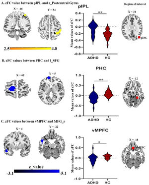 (A) the right postcentral gyrus with pIPL seed (B) the superior frontal gyrus with PHC seed; (C) the right middle prefrontal cortex with vMPFC seed. Abbreviations: PHC, parahippocampal cortex; vMPFC, ventral medial prefrontal cortex; MFG, middle frontal gyrus; SFG, superior frontal gyrus; r, right; l, left.