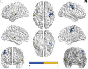 Representation of the most significant coordinates that show hypoactivation in patients with schizophrenia compared with healthy controls Note. The right precentral Gyrus is shown in blue and the left superior temporal Gyrus is shown in yellow.