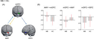 Effective connectivity seeded from medial OFC between MB and HC groups.