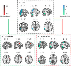 Regional activation abnormalities associated with the disorder group. Panel A shows regional activation abnormalities associated with individuals with DD and PDS. Panel B shows activation abnormalities associated with adults with disorders. Panel C shows activation abnormalities associated with children with disorders. Regions that survived with the statistical threshold set at p〈 0.005, a cluster extent of 10 voxels and the peak SDM-Z 〉 1. Coordinates reported in Montreal Neurological Institute space. Abbreviation: DD: developmental dyslexia; PDS: persistent developmental stuttering.