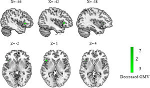 The results of structural atypical regions in children with disorders. Results showed a significant hypoactivation cluster of GMV in the left inferior frontal gyrus in children with DD and PDS compared to the control group. Regions that survived with the statistical threshold set at p〈 0.005, a cluster extent of 10 voxels and the peak SDM-Z 〉 1. Coordinates reported in Montreal Neurological Institute space. Abbreviation: DD: developmental dyslexia; GMV: gray matter volume; PDS: persistent developmental stuttering.