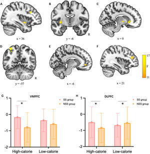 Univariate two-way functional magnetic resonance imaging analysis of variance results. (A) Right insula, right dorsolateral prefrontal cortex (DLPFC), and (B) left putamen showed significant higher activation in social support (SS) group than non-social support (NSS) group. (C) Right caudate, right globus pallidus internus (GPi), and (D) left superior parietal lobule (SPL) showed significant higher activation when facing low-calorie food cue than high-calorie food cue. (E) Left ventromedial prefrontal cortex (VMPFC) and right dorsolateral prefrontal cortex (DLPFC) showed significant activation in interaction between group and food calorie. R, right hemisphere. Brain activation pattern illustrated in bar graphs for (G) left VMPFC and (H) right DLPFC. The percent signal change for each region was extracted using MarsBaR region of interest toolbox for SPM. Asterisk denotes the significant activation difference between SS group and NSS group in that food calorie condition. Error bars represent SE. *p <0.05.