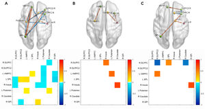 Schematic diagram representing (A) endogenous connections, (B) effective connectivity modulated by high-calorie food, and (C) effective connectivity modulated by low-calorie food, illustrating the differences between the social support group and the non-social support group. For clarity, in (B) and (C) not all nodes are shown. The positive modulations are shown in orange, and negative modulations are shown in blue. The brain diagram was visualized with the BrainNet Viewer. The matrixes showed the details of these connections (posterior probability > 0.999). DLPFC, dorsolateral prefrontal cortex; GPi, globus pallidus internus; SPL, superior parietal lobule; VMPFC, ventromedial prefrontal cortex; L, left; R, right.