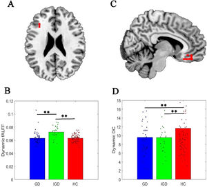 Temporal variations in brain activation and connectivity among GD, IGD, and HC participants. A: The left IFG showed significant group effects of dynamic fALFF; B: A bar graph displaying the results of post-hoc ROI analysis of dynamic fALFF; C: The right rectus/orbital frontal gyrus showed significant group effects of dynamic DC; D: A bar graph displaying the results of post-hoc ROI analysis of dynamic DC. Note: GD = Gambling disorder; IGD = Internet gaming disorder; HC = Healthy control; IFG = Inferior frontal gyrus; ROI = Regions of interest; fALFF = Fractional amplitude of low-frequency fluctuation; DC = Degree centrality. ⁎⁎p < 0.01. The whole-brain-wise significant threshold is FWE cluster-level q < 0.05, uncorrected p < 0.001.