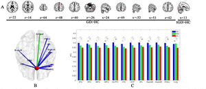 The between-group effects of temporal variability of functional connectivity of the right OFG. A: The brain regions showing higher temporal variability of functional connectivity with the right OFG in the GD or IGD groups when compared to the HC group; B: The connections with the right OFG showing higher temporal variability of functional connectivity with the right OFG in the GD (blue) or IGD (green) group when compared to the HC group; C: A bar graph for comparisons of temporal variation of functional connectivity with the right OFG in 12 ROIs among three groups. Note: GD = Gambling disorder; IGD = Internet gaming disorder; HC = Healthy control. l = Left; r = Right; OFG = Orbital frontal gyrus; IFG = Inferior frontal gyrus; MFG = Middle frontal gyrus; DLPFC = Dorsolateral prefrontal cortex; ITG = Inferior temporal gyrus; STP = Superior temporal pole; IPL = Inferior parietal lobule; SupraM = Supramarginal gyrus; Precu = Precuneus; Ling = Lingual gyrus; ROI= region of interest.