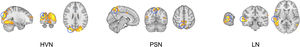Clusters with significant group differences, overlaid on their respective networks (HVN - higher visual network; LN – language network; PSN – posterior salience network).