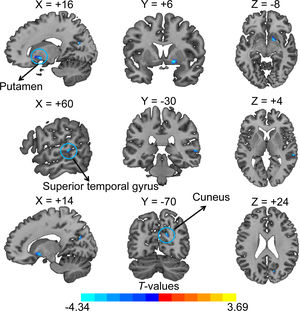 Brain regions showing significant structural differences between AD and HC (voxel p < 0.001, cluster p < 0.05, GRF corrected). The color scale represents T values.
