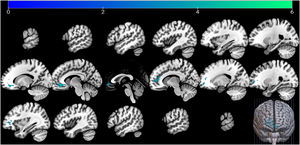Neural response to stress induction was negatively associated with the changes in gBOLD-CSF coupling (Stress > No-stress, FWE-corrected p < 0.05).