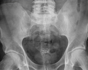 Radiografía simple anteroposterior. Se aprecia una imagen radiopaca vermiforme en la pelvis menor.