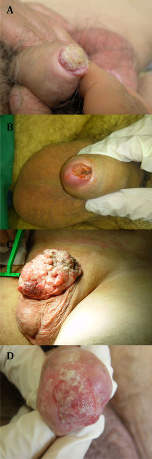 Imágenes de carcinoma epidermoide de pene en distintos estadios evolutivos. A)Estadio T1. B)Estadio T3. C)Estadio T4. D)Estadio T3. (Imágenes obtenidas de pacientes del Servicio de Urología del Hospital Clínico Universitario San Cecilio.)