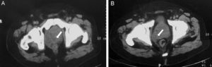 La tomografía axial computarizada muestra un área hipodensa en la región inferior derecha de la próstata asociada a una colección líquida que se extiende hacia la fosa isquiorrectal de 4,3×3,8×4cm.