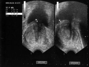 Ecografía transrectal en la que se observa una próstata de 73cm3 con una ecoestructura homogénea, con algunas calcificaciones intraprostáticas, sin visualizar abscesos.