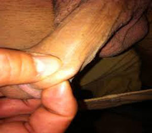 The palpable thrombotic superficial vein of the penis.