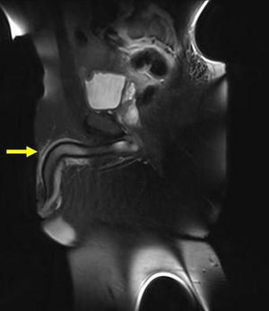 Magnetic resonance imaging (MRI) the sagittal shows, arrow: superficial penil vein trombosis (T1).