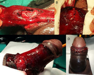 A) Se observa la rotura del cuerpo cavernoso derecho; B) Se aprecia la sutura del mismo con Vycril® 3/0 mediante puntos sueltos; C) Se realiza erección artificial con suero salino comprobando una erección normal sin fuga en la zona de la sutura, y D) Se comprueba al finalizar la cirugía, la correcta morfología peneana.
