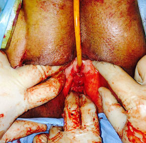 Transobturatory tape and urethral repair operation.