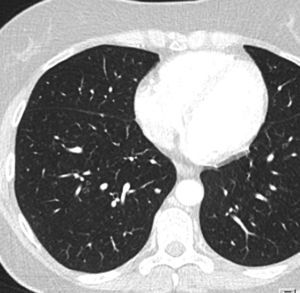 TC de tórax (con ventana para estudio del parénquima pulmonar) 5 meses tras la cirugía, tras 3 meses de tratamiento sistémico. Se pone de manifiesto respuesta parcial al tratamiento según RECIST 1.1. En la imagen se muestra disminución del tamaño del nódulo pulmonar basal derecho representado en la figura 3.