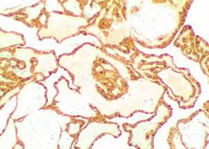 Imagen inmunohistoquímica de tinción para calretinina (tiñe las células mesoteliales).