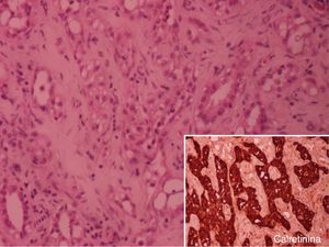 H. E., ampl. 100X. A neoplasia tem aspeto epitelial com padrão tubular e as células, umas têm citoplasma eosinófilo e outras têm citoplasma claro vacuolizado; caixa – imunocitoquímica 400X – positividade acentuada para calretinina.