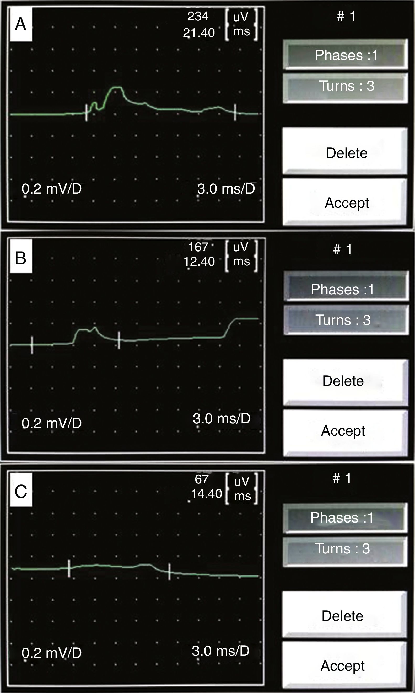The application of spontaneous corpus cavernosum EMG to assess the ...