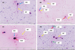 Morphological (Hematoxylin/Eosin) staining showed the structure of the patient