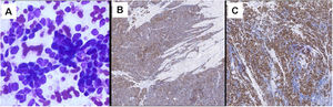 Hematoxylin–eosin prostatic tissue with (A) SCC pattern. (B) Positivity with antibodies to CD56. (C) High mitotic rate with Ki67. Penile FNAC SCC pattern.