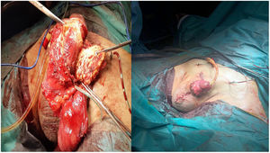 Excision of paraffinoma and surgical result.