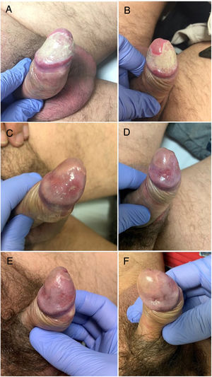 (A and B) Glans penis on admission; (C and D) After 2 months; (E and F) After 4 months.