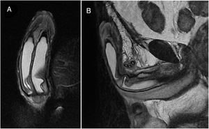 Coronal (A) and sagittal (B) MRI T2-weighted images after inflation reveal proper cylinder positioning without any complication.