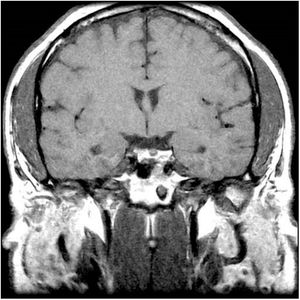 Resonancia magnética cerebral (plano coronal).