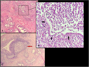 (A) 100×, H&E, glandular destruction. (B) 1000×, H&E, glandular destruction, fragmented gland epithelium (black arrow) and intense inflammation including neutrophils. (C) 100×, H&E, lymphoid follicle with germinal center (red arrow).