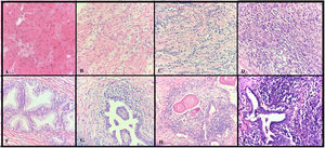 400×, H&E, inflammation in fibromuscular stroma. (A) No inflammation, (B) mild inflammation, (C) moderate inflammation, (D) severe inflammation. Periglandular inflammation (E) no inflammation, (F) mild inflammation, (G) moderate inflammation, (H) severe inflammation.