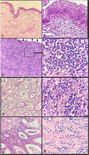 (A) 100×, H&E, mild inflammation involving only lymphocytes under the urethral epithelium in the non-stricture group. (B) ×200, H&E, inflammation in the stricture group with moderate eosinophils and plasmocytes under the urethral epithelium. (C) ×100, H&E, severe inflammation involving eosinophils and plasmocytes in sub-urethral epithelium in the stricture group, destroyed by the severity of epithelial inflammation (black arrow). (D) ×1000, H&E, severe inflammation involving eosinophils and plasmocytes in the stricture group. (E) ×200, H&E, periglandular, severe inflammation involving eosinophils and plasmocytes in the stricture group. (F) ×1000, H&E, eosinophils (red arrow) and plasmocytes (blue arrow) in the stricture group. (G) ×200, H&E, periglandular inflammation involving only lymphocytes in the non-stricture group. (H) ×1000, H&E, eosinophils and plasmocytes do not appear in the non-stricture group.