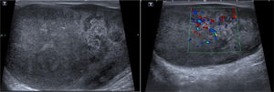 Ecografía testicular con el parénquima desestructurado, ocupado totalmente por tumor y con hipoperfusión del parénquima.