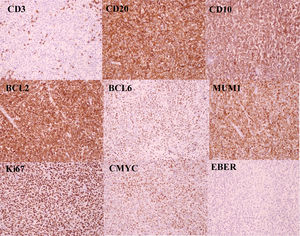 La neoplasia mostró fenotipo de línea B (CD20+, CD3−), subtipo centrogerminal (algoritmo de Hans: CD10+), double hit (BCL2+, BCL6+). El índice proliferativo medido mediante Ki67 fue de un 90%. La neoplasia mostró una sobreexpresión inmunohistoquímica de C-Myc, pero el estudio molecular resultó negativo para la translocación mediante FISH. El estudio de CISH para EBER no detectó virus de Epstein-Barr. El estudio de CD30 resultó negativo.