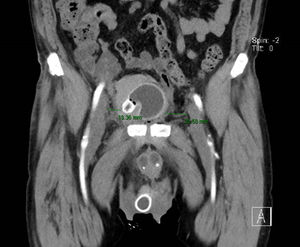 CT scan image of SR reservoir demonstrating closer distance to iliac vessels than commonly reported.