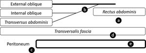 Schematic of possible reservoir locations within the abdominal wall (adapted from Ziegelmann and coll.40). (a) Anterior to transversalis fascia and posterior to rectus abdominis. (b) Posterior to external oblique fascia. (c) Retroperitoneal. (d) Preperitoneal. (e) Intraperitoneal.