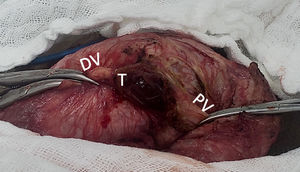 The thrombus was exposed while the SDPV was proximal and distally clamped. DV (distal vein), T (thrombus), PV (proximal vein).