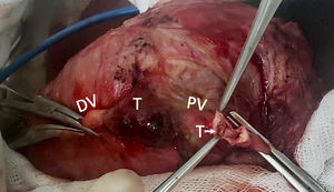 Proximal segment was opened for irrigation with heparanized saline solution. DV (distal vein), T (thrombus), PV (proximal vein).