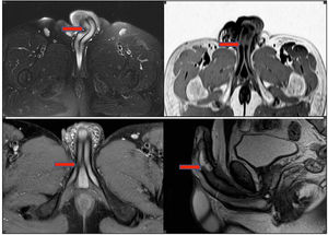 Penile MR images of the patients.