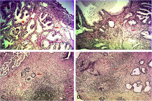 The assessment of prostate tissue inflammation via H&E staining (100×). (A) Non-inflammatory BPH; normal prostate gland (red arrow). (B) Mild-inflammatory BPH; scattered distribution of lymphocytes around the gland (red arrow). (C) Moderate-inflammatory BPH; nonconfluent lymphoid nodules (red arrow). (D) Severe-inflammatory BPH; large inflammatory areas with confluence of infiltrates (red arrow).