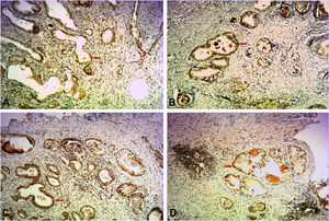Immunohistochemistry staining of IL-6 in the 4 groups (100×). (A) Non-inflammatory BPH; (B) mild-inflammatory BPH; (C) moderate-inflammatory BPH; (D) severe-inflammatory BPH; prostate glandular epithelium within a staining positive for IL-6 (red arrow).