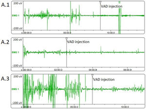 Corpus cavernosum electromyography (cc-EMG) samples. (A.1) cc-EMG sample of a patient with outpatient COVID-19 (group 1), (A.2) cc-EMG sample of a patient hospitalized due to COVID-19 (group 2), (A.3) cc-EMG sample of a patient without COVID-19 (group 3).