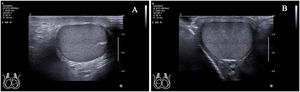 Standard transverse axis view of the testicle. The rete testis of the left testicle (A) is located at the mid-lateral edge. The rete testis of the right testicle (B) is located in the middle zone of the posterior lateral edge.